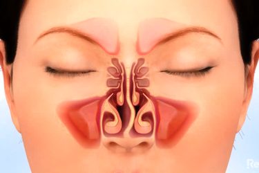 Septoplasty Surgery in India, Best ENT Centre for Septoplasty Surgery in India, Nose Bone Correction Surgery, Surgery for Cough and Cold in India